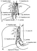 Abbildung 5: Lebertransplantion - Operation