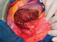 Abbildung 6: Lebertransplantation - Spenderoperation