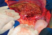 Abbildung 7: Lebertransplantation - Empfngeroperation
