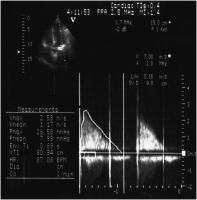 Abbildung 4: Echokardiographie - CW-Doppler