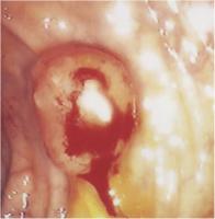 Abbildung 4-b: Endoskopie - Polypse Strukturen