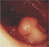 Abbildung 4-c: Endoskopie - Polypse Strukturen