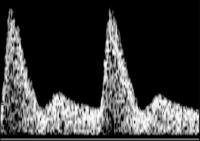 Abbildung 2-b: Arteria uterina - Dopplersonographie