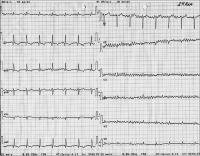 Abbildung 1: Kammerflimmern - QRS-Komplex