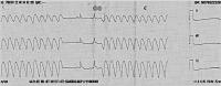 Abbildung 3: Ventrikulre Tachykardie - Sinusrhythmus
