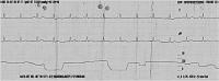 Abbildung 4: Normofrequenter Sinusrhythmus