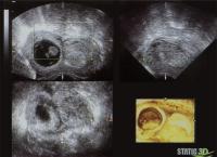Abbildung 2: Embryo - 3D-Ultraschall