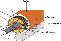Abbildung 1: Refertilisierung - Tubenanastomose