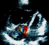 Abbildung 1: Pulmonale Hypertonie