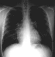 Abbildung 2: Pulmonale Hypertonie
