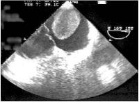 Figure 2: Transesophageal Echocardiography