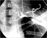 Abbildung 6: Takaysu-Arteriitis