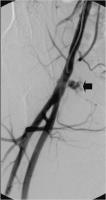 Abbildung 1: Iatrogenes Pseudoaneurysma