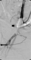 Abbildung 2: Pseudoaneurysma - Ballonokklusion
