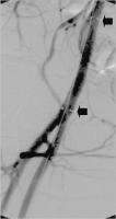 Abbildung 4: Stentgraft-Implantation