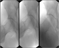 Abbildung 5: Stengraft