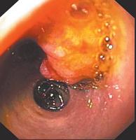 Abbildung 3: Ductus hepaticus