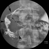 Abbildung 2: Morbus Crohn - Duodenum