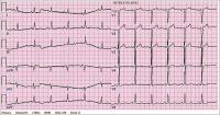 Abbildung 1: Normofrequenter Sinusrhythmus