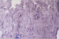 Abbildung 2c: Immunhistochemie/Endomyokardbiopsie