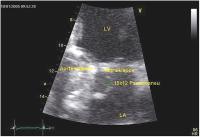 Abbildung 1: Intrakardiales Pseudoaneurysma