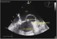 Abbildung 2: Intrakardiales Pseudoaneurysma