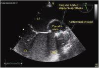 Abbildung 3: Intrakardiales Pseudoaneurysma