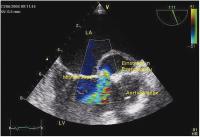 Abbildung 4: Intrakardiales Pseudoaneurysma