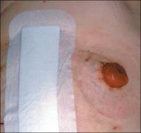 Abbildung 5: Stoma nach Rektumamputation