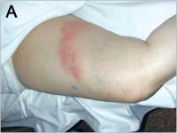 Abbildung 3-A: Varikophlebitis - Duplexsonographie