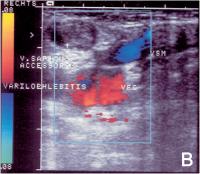 Abbildung 3-B: Varikophlebitis - Duplexsonographie