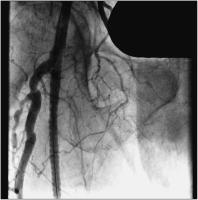 Abbildung 6: Implantierter Stent