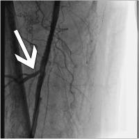 Abbildung 7: Implantierter Stent