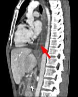 Abbildung 2c: Coronale MDCT-Rekonstruktion der Fistel