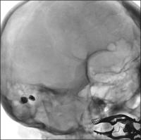 Abbildung 2: Intrazerebrale Angiographie