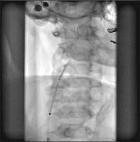 Abbildung 4: Open-cell-Nitinolstent