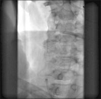 Abbildung 8: Abschluangiographie