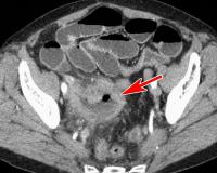Abbildung 1: Tumor - Ileum