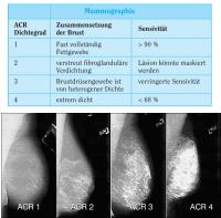 Abbildung 1: Mammographie - ACR