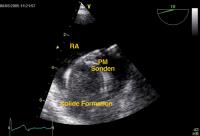 Abbildung 1: Rechtsatriale Thrombose nach 2-Kammer-Schrittmacherimplantation