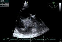 Abbildung 2: Rechtsatriale Thrombose nach 2-Kammer-Schrittmacherimplantation