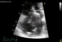 Abbildung 3: Rechtsatriale Thrombose nach 2-Kammer-Schrittmacherimplantation