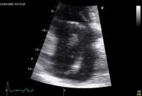 Abbildung 4: Rechtsatriale Thrombose nach 2-Kammer-Schrittmacherimplantation