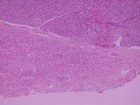 Abbildung 7: Nierenzellkarzinom - Histologie