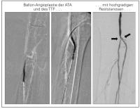 Abbildung 3: Ballon-Angioplastie