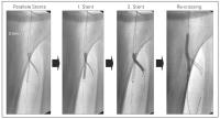 Abbildung 4: Crush-Stenting