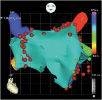 Abbildung 5a: Elektroanatomisches Mapping
