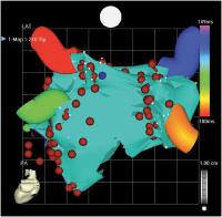 Abbildung 5b: Elektroanatomisches Mapping