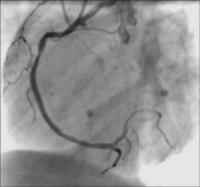 Abbildung 4: TIMI-3-Flu - Stent