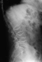 Abbildung 3: Osteoporose - Radiologie